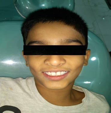 Patient with a history fractured incisors